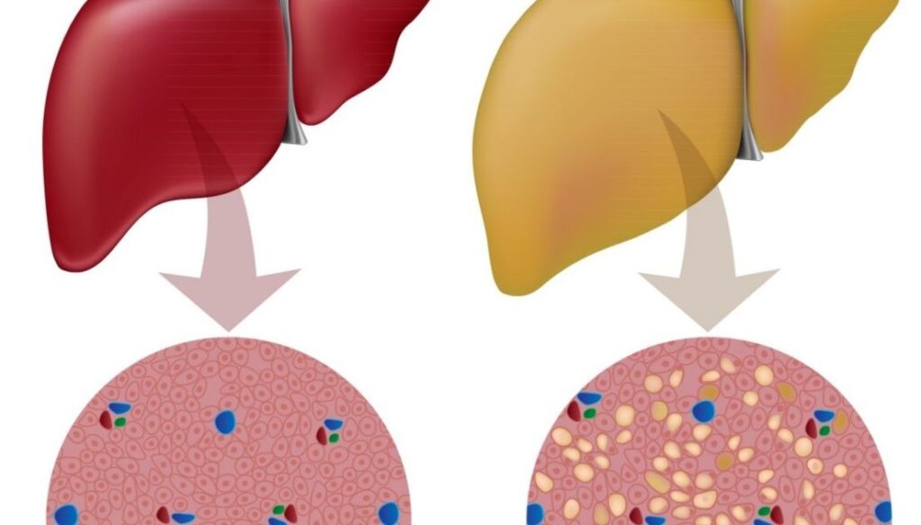 Dấu hiệu quan trọng của bệnh gan nhiễm mỡ cần đi khám sớm 2 66fd22c883