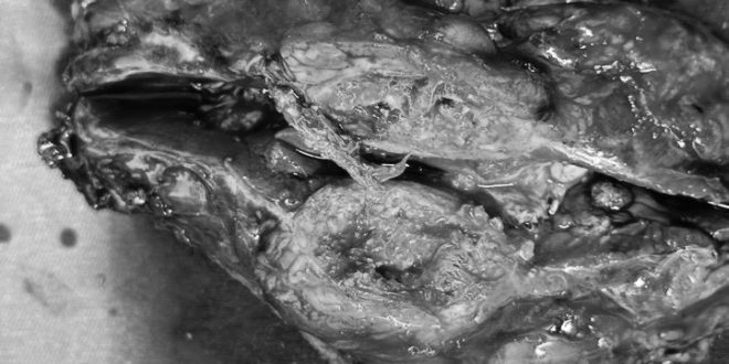 Hy hữu: U thận giả do gạc bỏ quên trong ổ bụng 14 năm 2 u than gia 6790